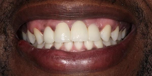 Dental Implants after at Middle Tennessee Prosthodontics in Brentwood, TN