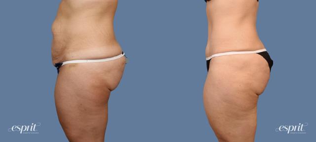 Tummy Tuck result at Esprit Cosmetic Surgeons in Tualatin, OR