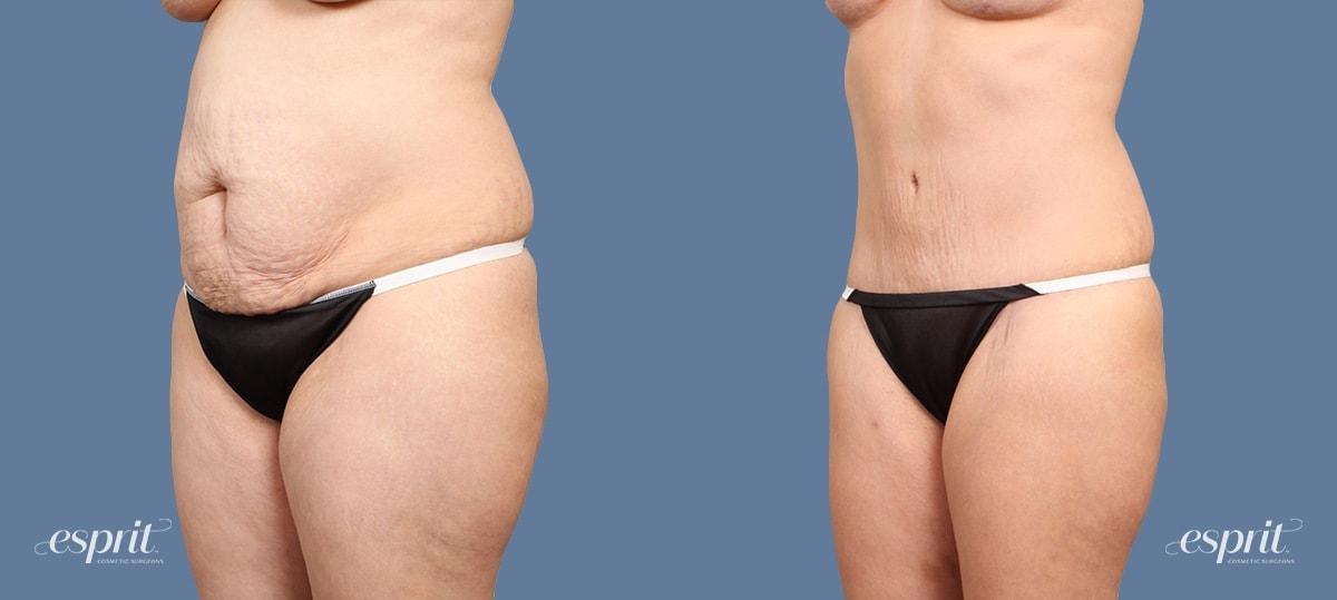 Esprit Cosmetic Surgeons tummy tuck result — Tualatin, OR