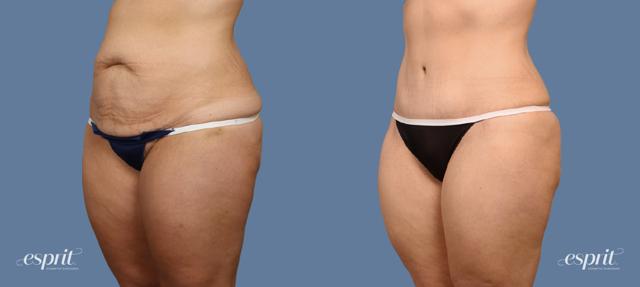 Tummy Tuck result at Esprit Cosmetic Surgeons in Tualatin, OR