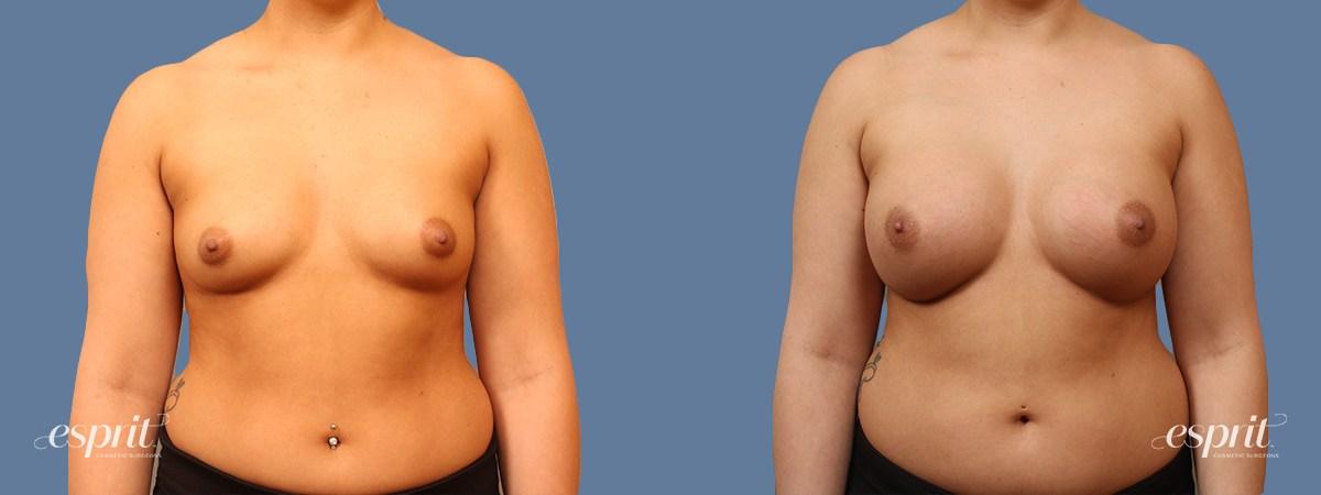 Esprit Cosmetic Surgeons breast augmentation result — Tualatin, OR