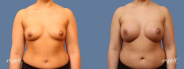 Breast Augmentation result at Esprit Cosmetic Surgeons in Tualatin, OR