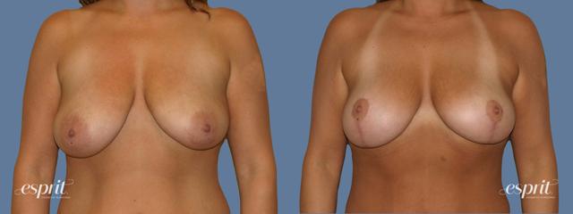 Breast Lift result at Esprit Cosmetic Surgeons in Tualatin, OR