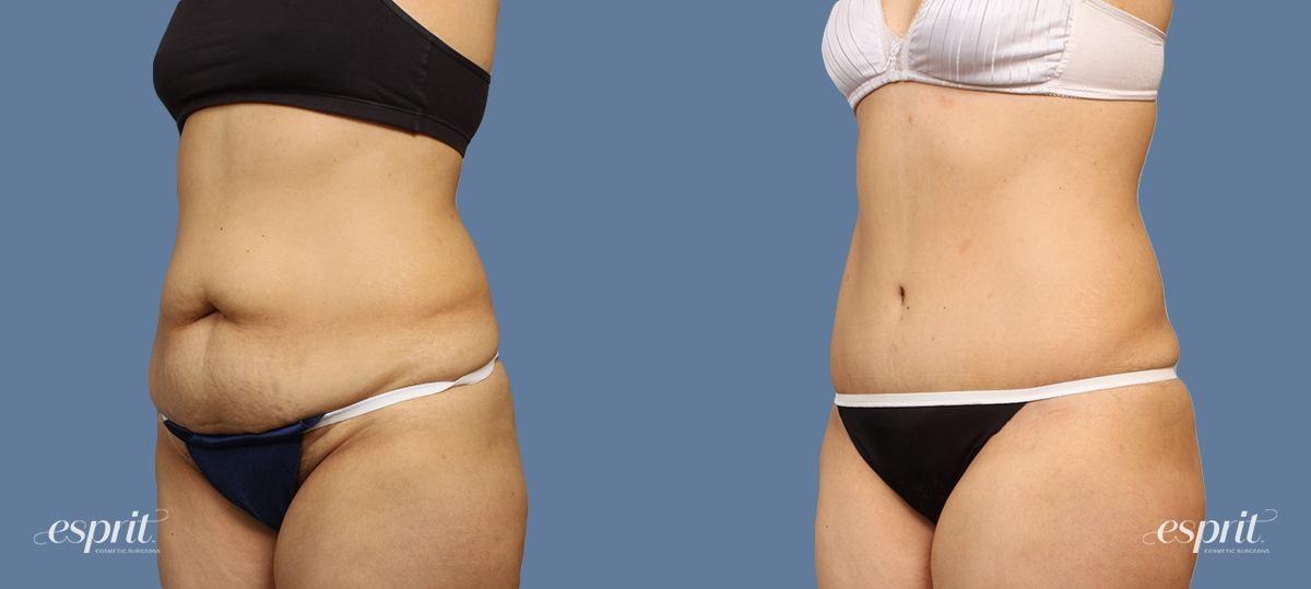 Esprit Cosmetic Surgeons tummy tuck result — Tualatin, OR
