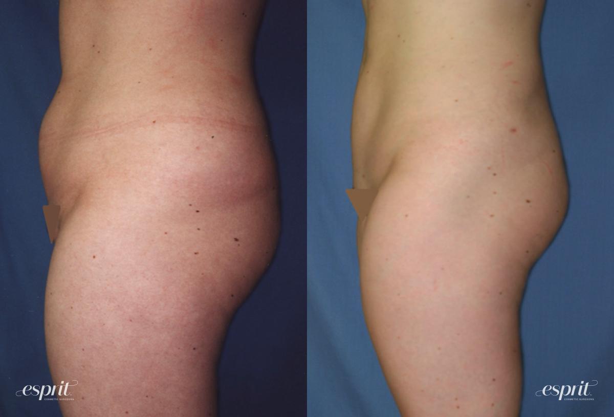 Esprit Cosmetic Surgeons liposuction result — Tualatin, OR