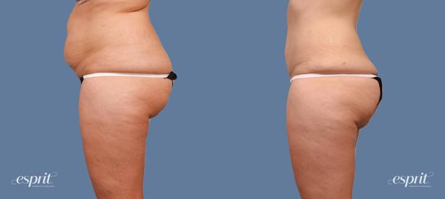 Tummy Tuck result at Esprit Cosmetic Surgeons in Tualatin, OR