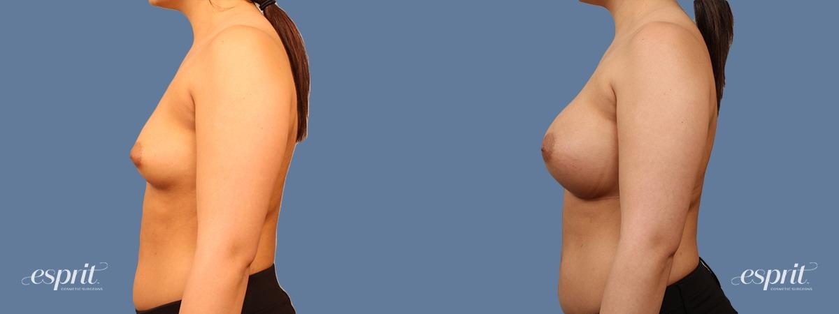 Esprit Cosmetic Surgeons breast augmentation result — Tualatin, OR