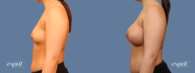 Breast Augmentation result at Esprit Cosmetic Surgeons in Tualatin, OR