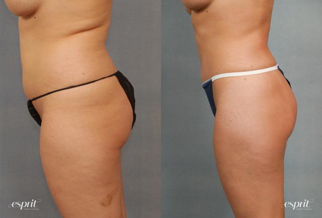 Liposuction result at Esprit Cosmetic Surgeons in Tualatin, OR