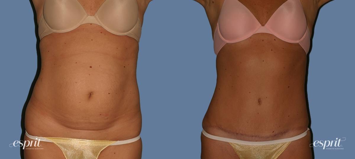 Esprit Cosmetic Surgeons tummy tuck result — Tualatin, OR