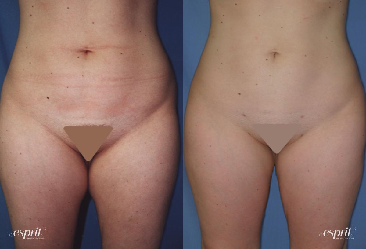 Esprit Cosmetic Surgeons liposuction result — Tualatin, OR