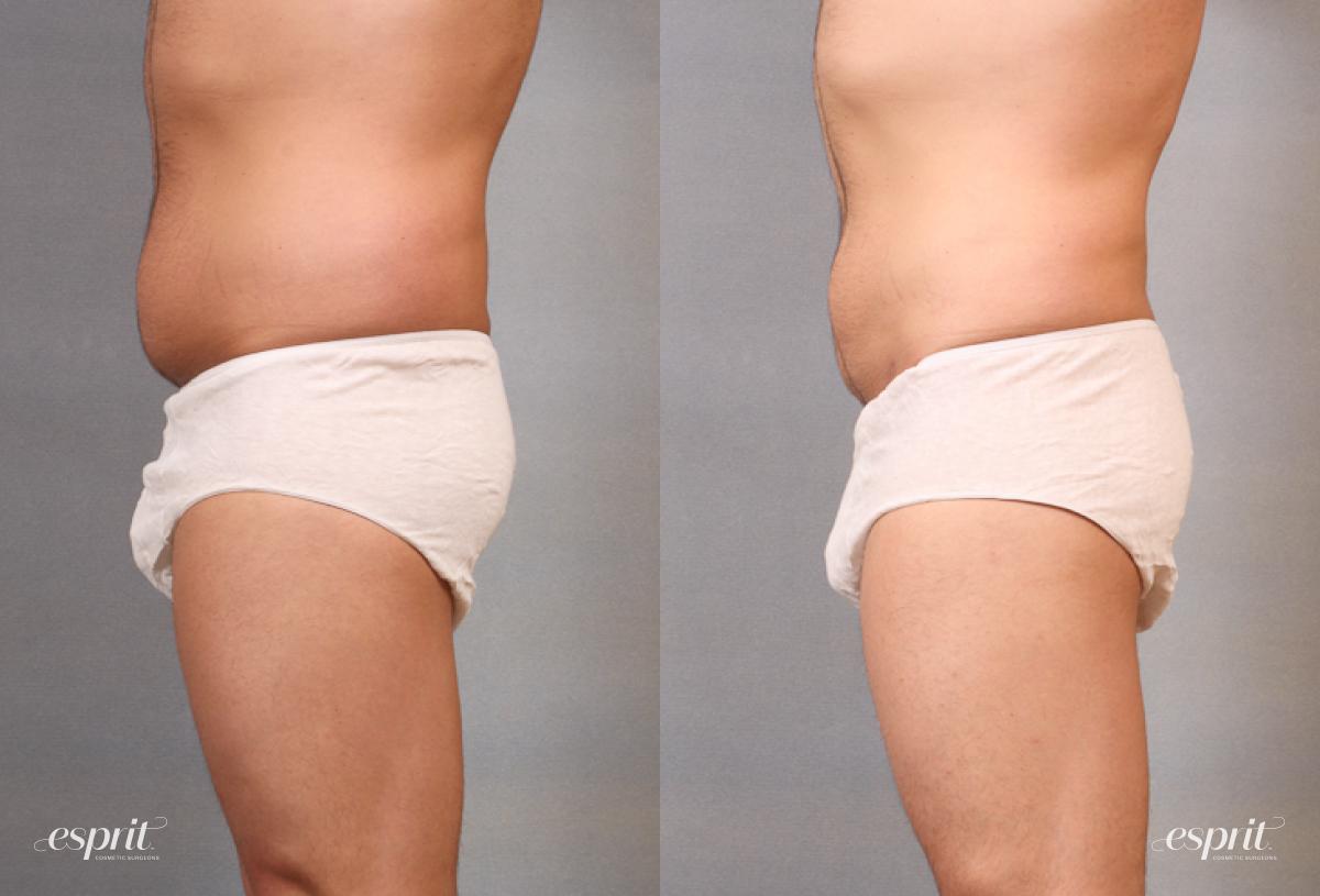 Esprit Cosmetic Surgeons liposuction result — Tualatin, OR