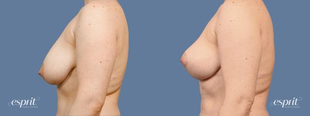 Breast Lift result at Esprit Cosmetic Surgeons in Tualatin, OR