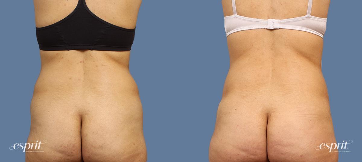 Esprit Cosmetic Surgeons tummy tuck result — Tualatin, OR