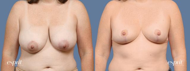 Breast Reduction result at Esprit Cosmetic Surgeons in Tualatin, OR