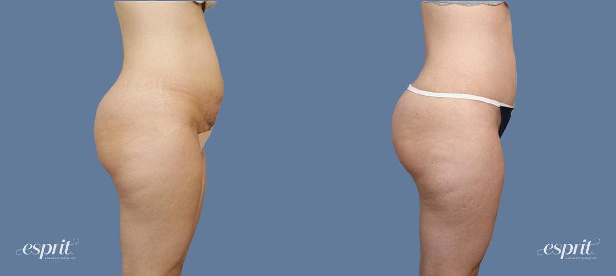 Esprit Cosmetic Surgeons tummy tuck result — Tualatin, OR