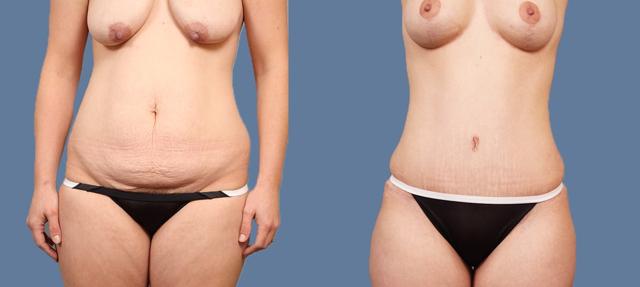 Mommy Makeover result at Esprit Cosmetic Surgeons in Tualatin, OR