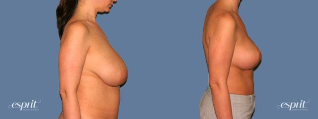 Breast Reduction result at Esprit Cosmetic Surgeons in Tualatin, OR