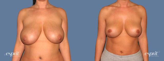 Breast Reduction result at Esprit Cosmetic Surgeons in Tualatin, OR