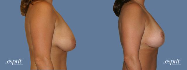 Breast Lift result at Esprit Cosmetic Surgeons in Tualatin, OR