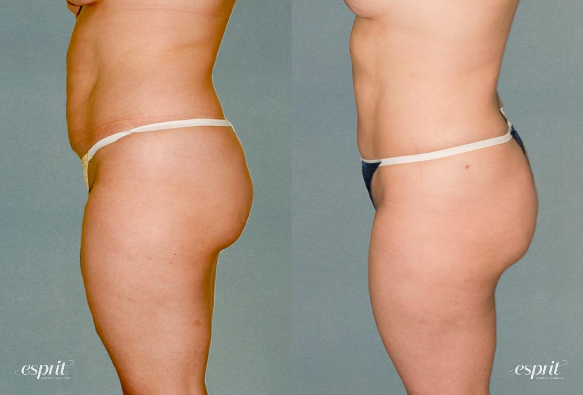 Esprit Cosmetic Surgeons liposuction result — Tualatin, OR