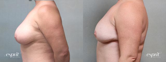 Breast Reduction result at Esprit Cosmetic Surgeons in Tualatin, OR