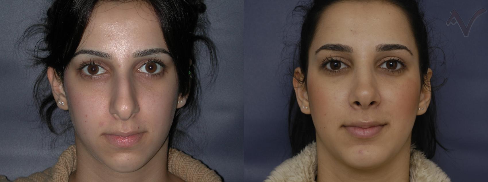 Armen Vartany, MD, FACS: Plastic Surgery and Laser Center chin implant result — Burbank, CA