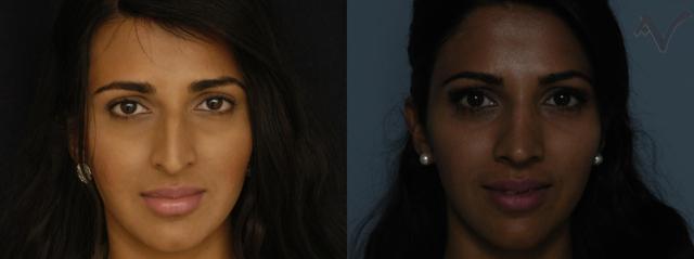 Rhinoplasty result at Armen Vartany, MD, FACS: Plastic Surgery and Laser Center in Burbank, CA