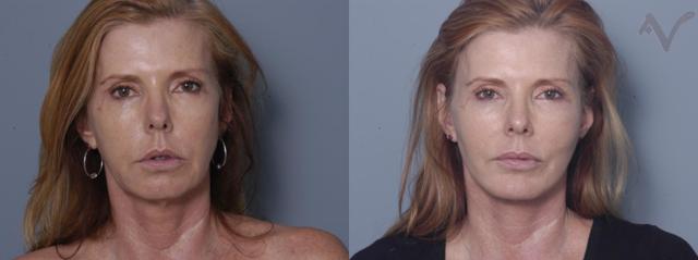 Deep Plane Facelift result at Armen Vartany, MD, FACS: Plastic Surgery and Laser Center in Burbank, CA