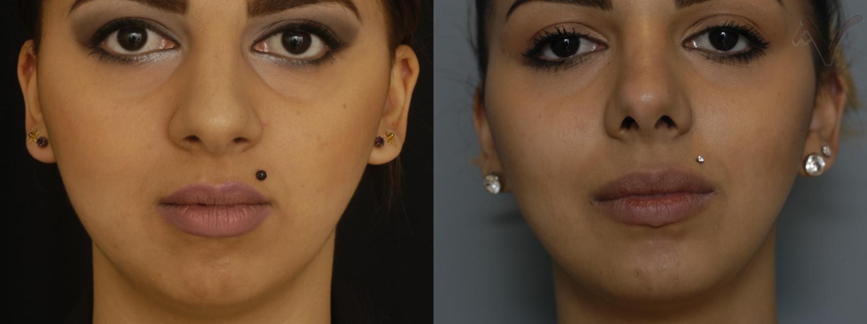 Armen Vartany, MD, FACS: Plastic Surgery and Laser Center chin implant result — Burbank, CA