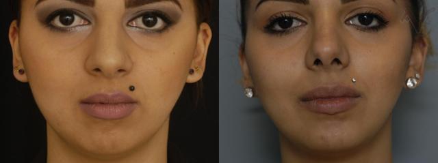 Chin Implant result at Armen Vartany, MD, FACS: Plastic Surgery and Laser Center in Burbank, CA