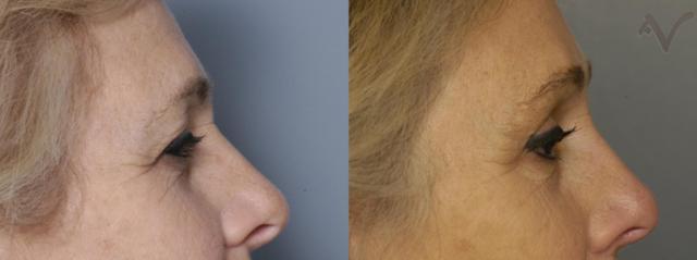 Brow Lift result at Armen Vartany, MD, FACS: Plastic Surgery and Laser Center in Burbank, CA