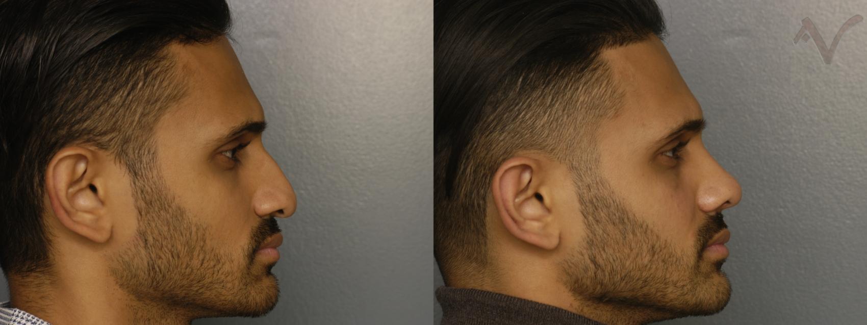 Armen Vartany, MD, FACS: Plastic Surgery and Laser Center rhinoplasty result — Burbank, CA
