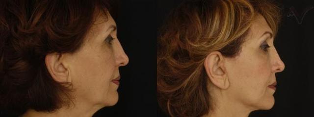 Deep Plane Facelift result at Armen Vartany, MD, FACS: Plastic Surgery and Laser Center in Burbank, CA