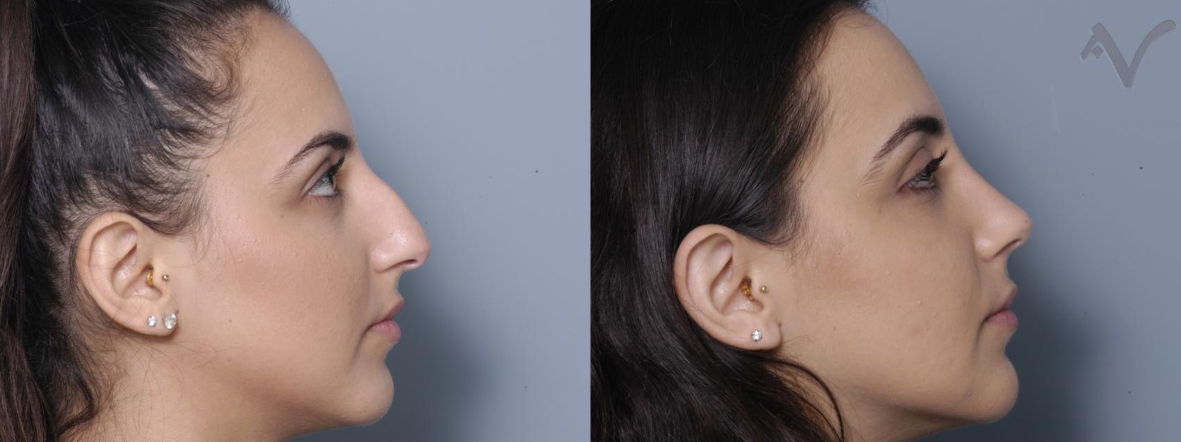 Armen Vartany, MD, FACS: Plastic Surgery and Laser Center rhinoplasty result — Burbank, CA