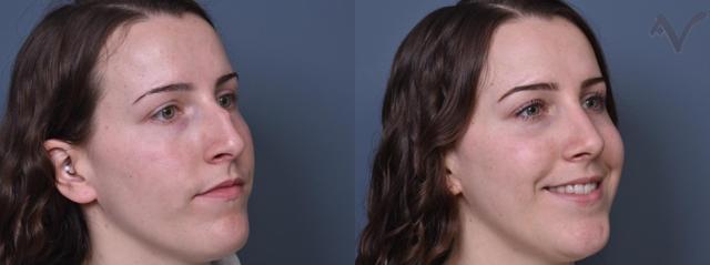Rhinoplasty result at Armen Vartany, MD, FACS: Plastic Surgery and Laser Center in Burbank, CA