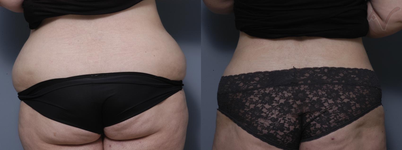 Armen Vartany, MD, FACS: Plastic Surgery and Laser Center liposuction result — Burbank, CA