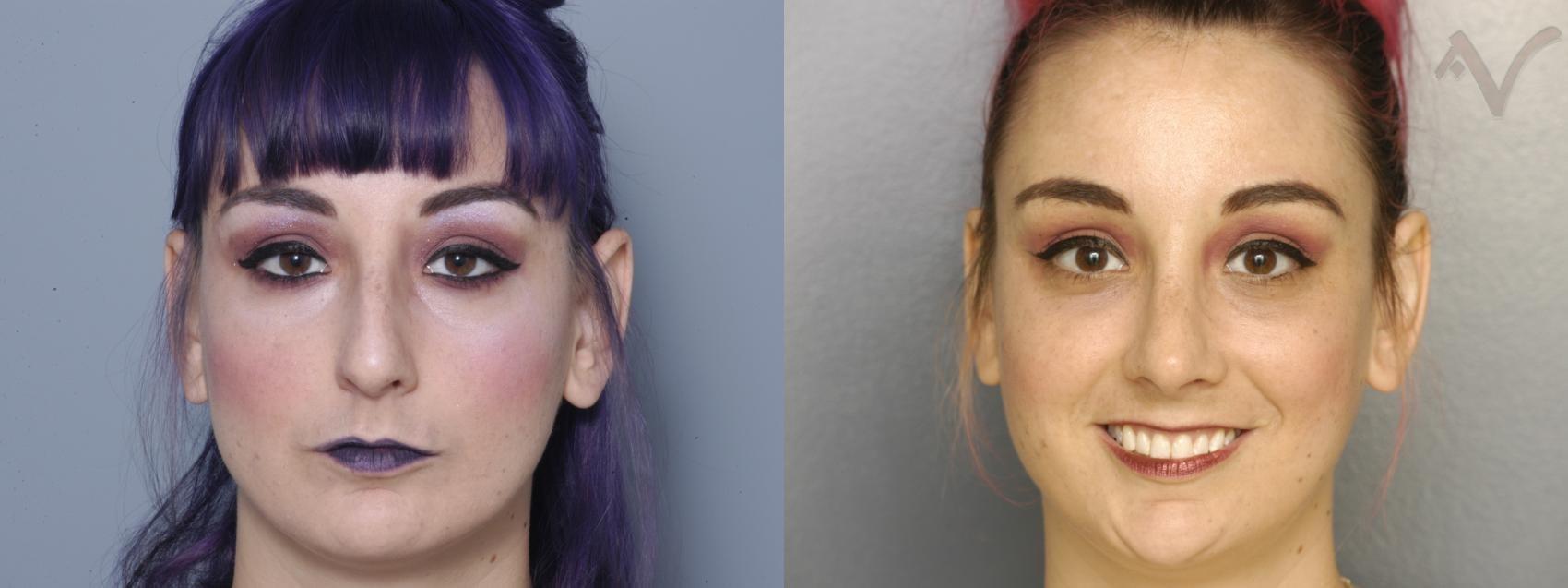 Armen Vartany, MD, FACS: Plastic Surgery and Laser Center rhinoplasty result — Burbank, CA