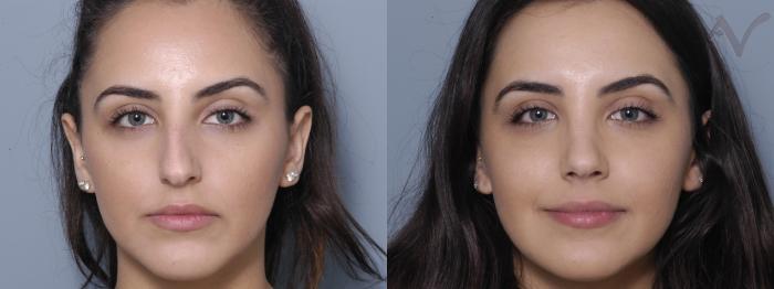 Armen Vartany, MD, FACS: Plastic Surgery and Laser Center rhinoplasty result — Burbank, CA