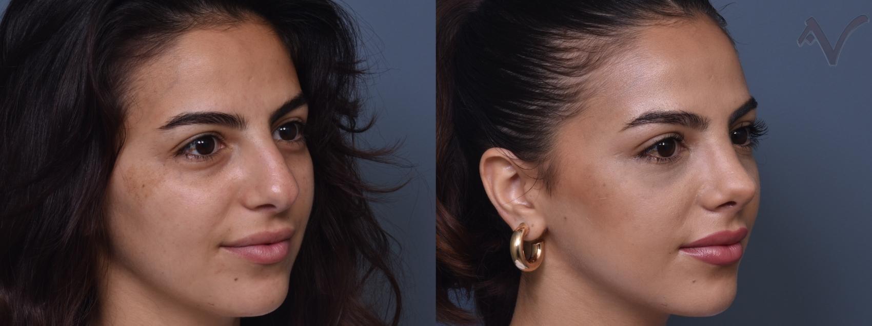 Armen Vartany, MD, FACS: Plastic Surgery and Laser Center rhinoplasty result — Burbank, CA