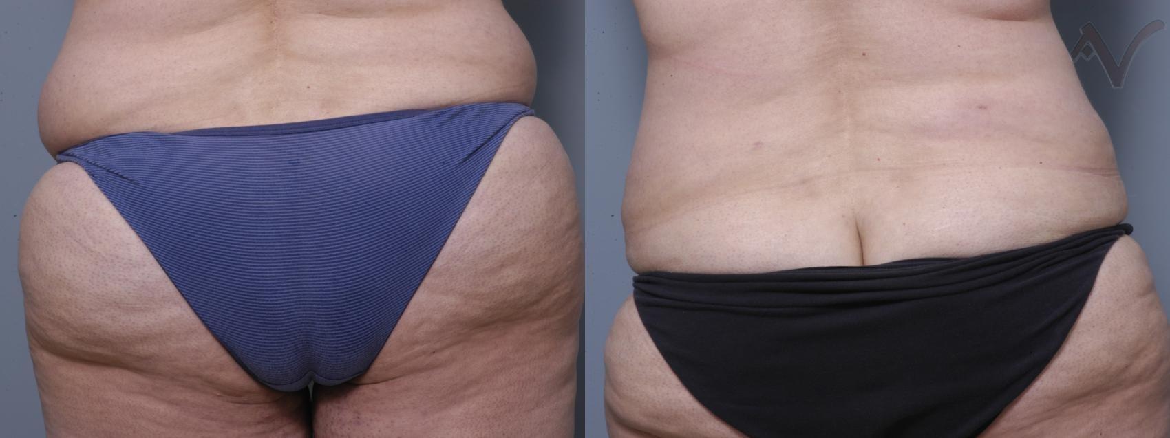 Armen Vartany, MD, FACS: Plastic Surgery and Laser Center liposuction result — Burbank, CA