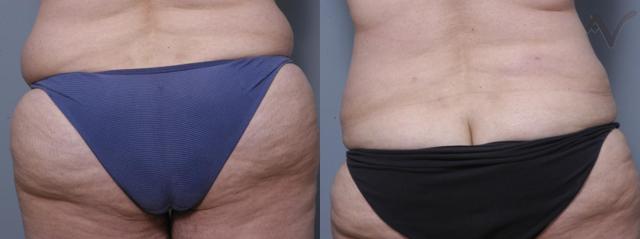 Liposuction result at Armen Vartany, MD, FACS: Plastic Surgery and Laser Center in Burbank, CA