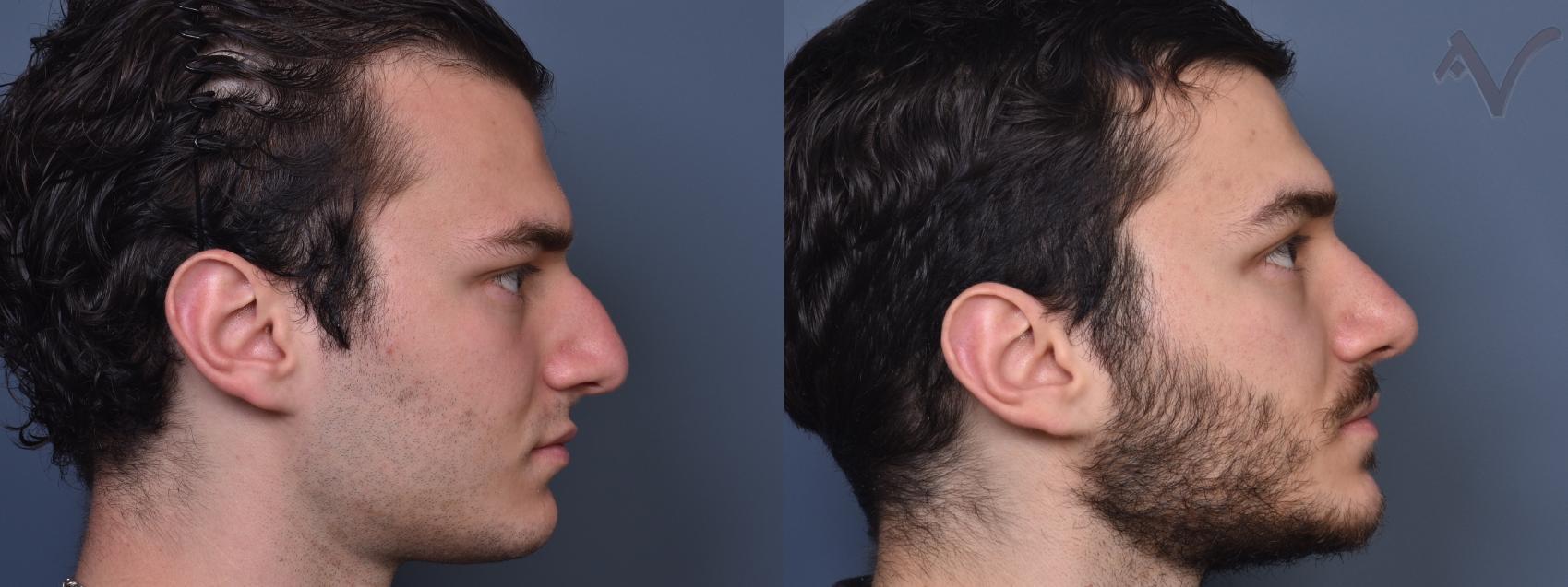 Armen Vartany, MD, FACS: Plastic Surgery and Laser Center rhinoplasty result — Burbank, CA