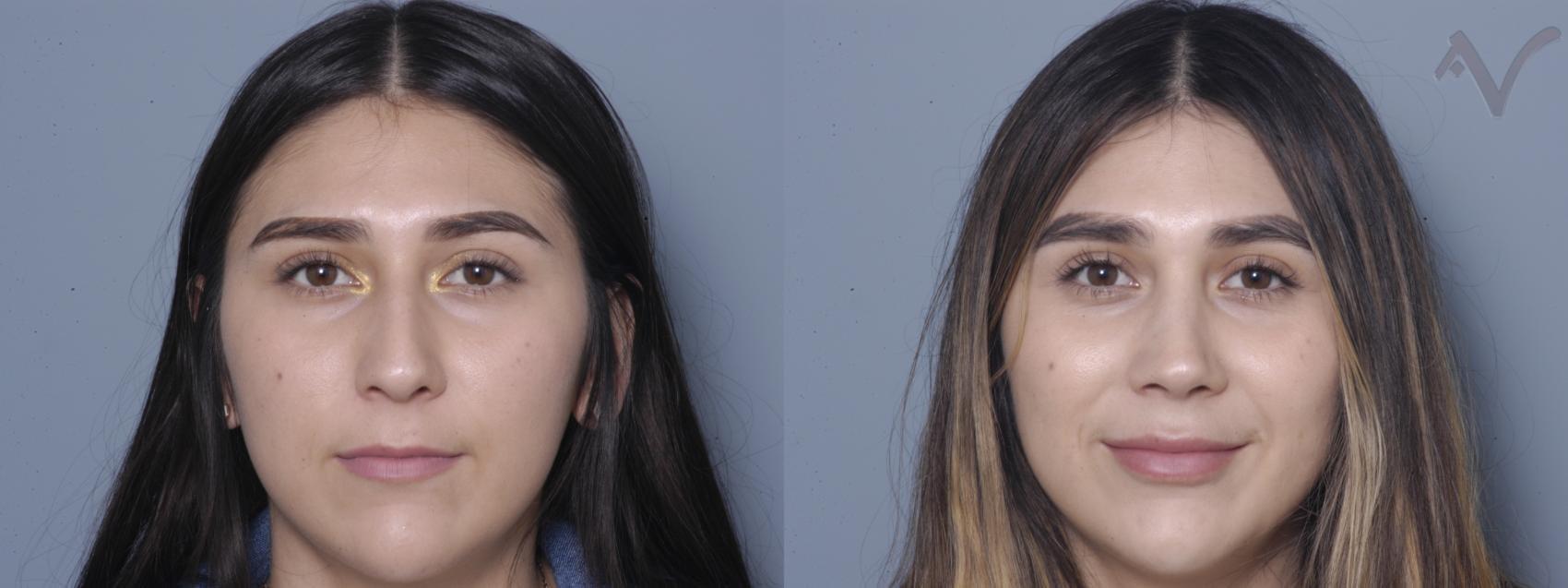 Armen Vartany, MD, FACS: Plastic Surgery and Laser Center rhinoplasty result — Burbank, CA