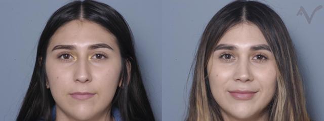 Rhinoplasty result at Armen Vartany, MD, FACS: Plastic Surgery and Laser Center in Burbank, CA