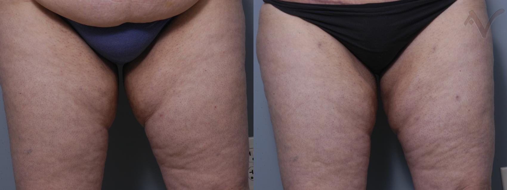 Armen Vartany, MD, FACS: Plastic Surgery and Laser Center liposuction result — Burbank, CA