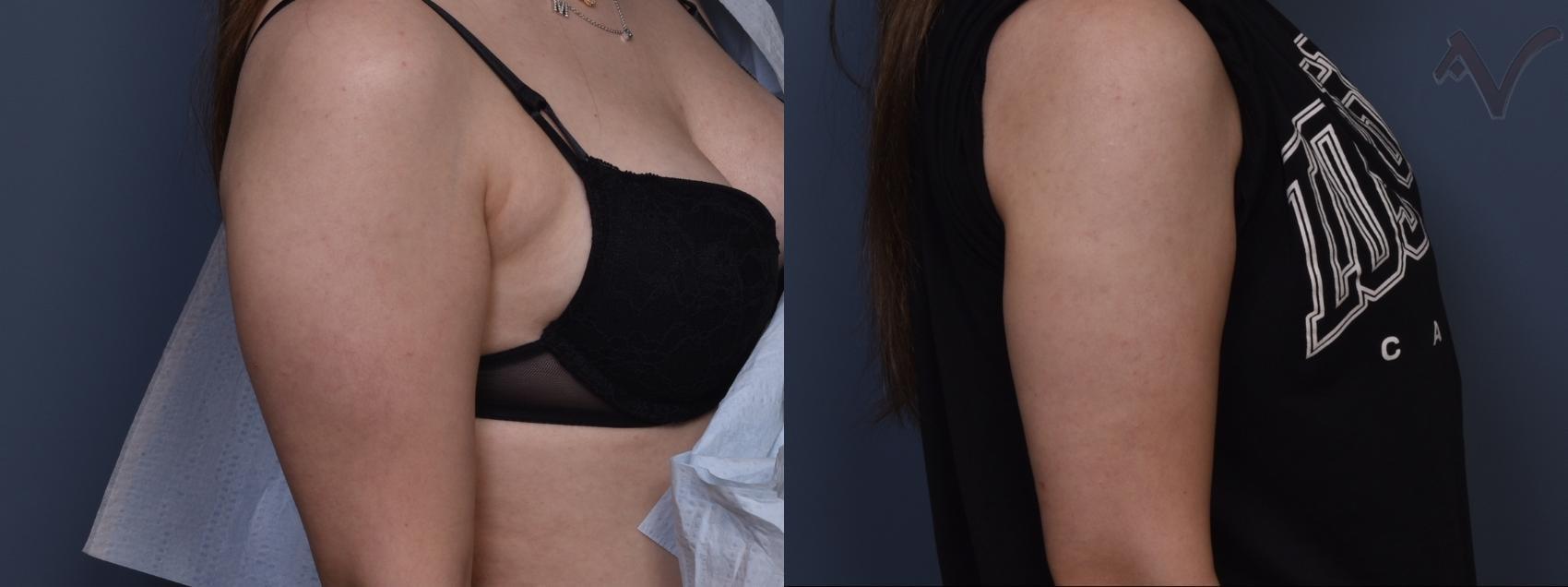 Armen Vartany, MD, FACS: Plastic Surgery and Laser Center liposuction result — Burbank, CA