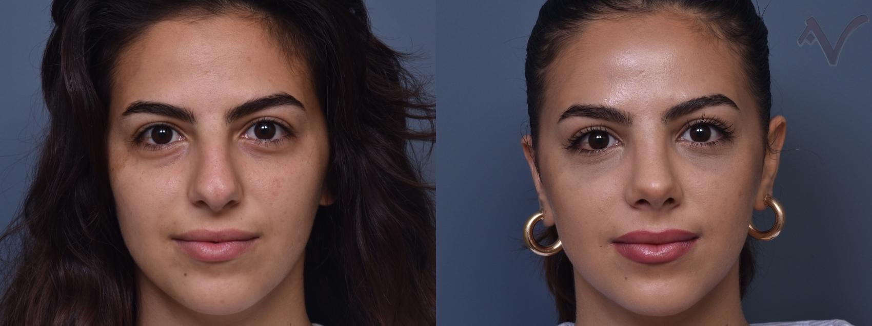 Armen Vartany, MD, FACS: Plastic Surgery and Laser Center rhinoplasty result — Burbank, CA