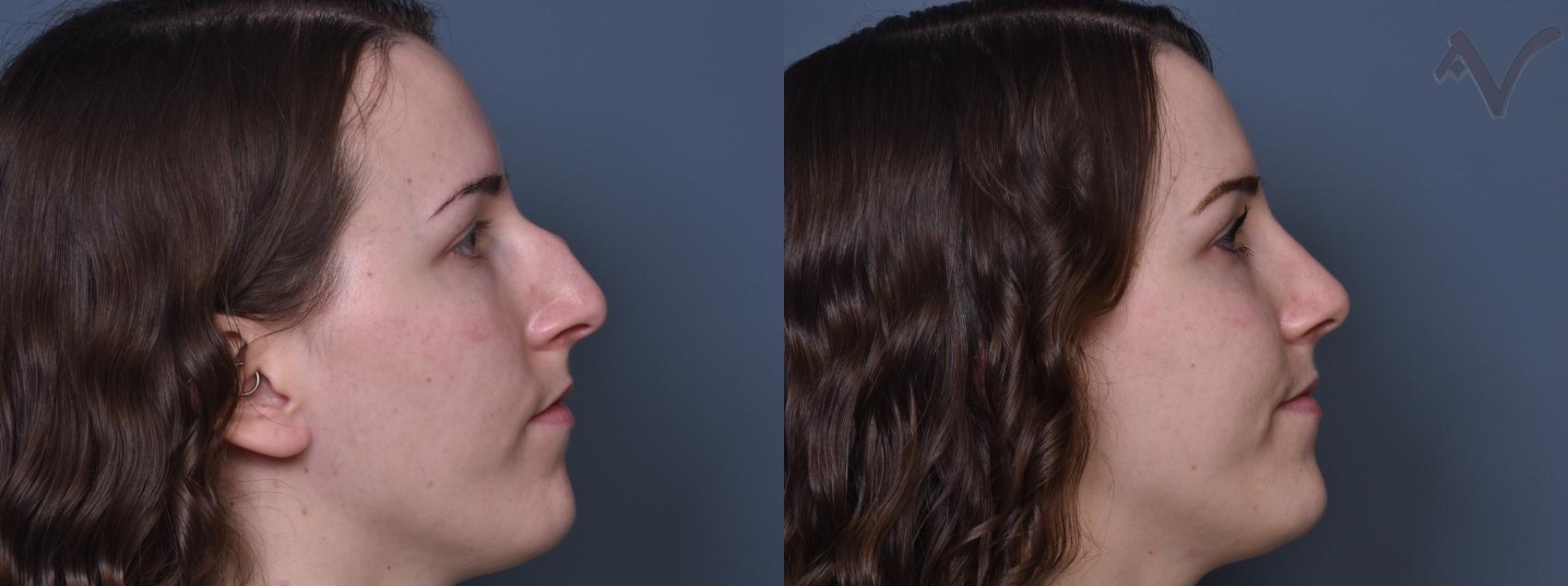 Armen Vartany, MD, FACS: Plastic Surgery and Laser Center rhinoplasty result — Burbank, CA