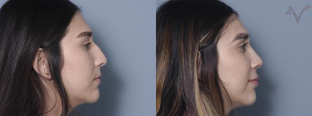 Rhinoplasty result at Armen Vartany, MD, FACS: Plastic Surgery and Laser Center in Burbank, CA